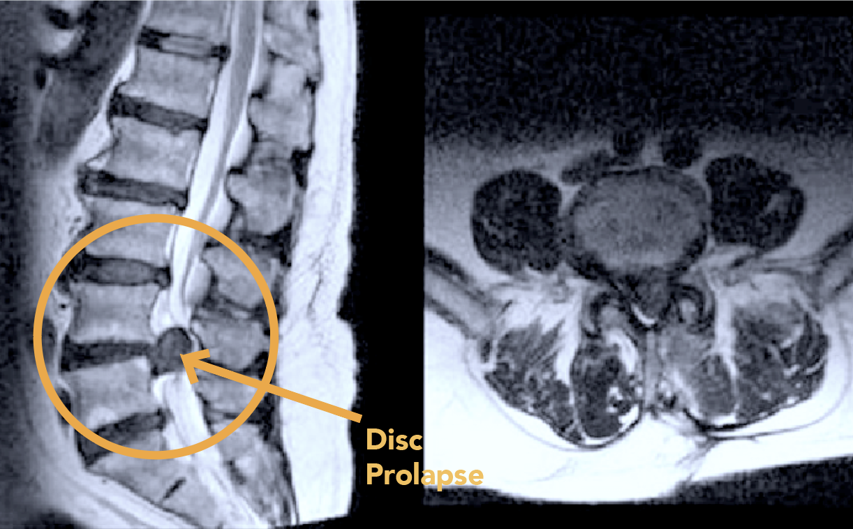 Nerve Root Blocks