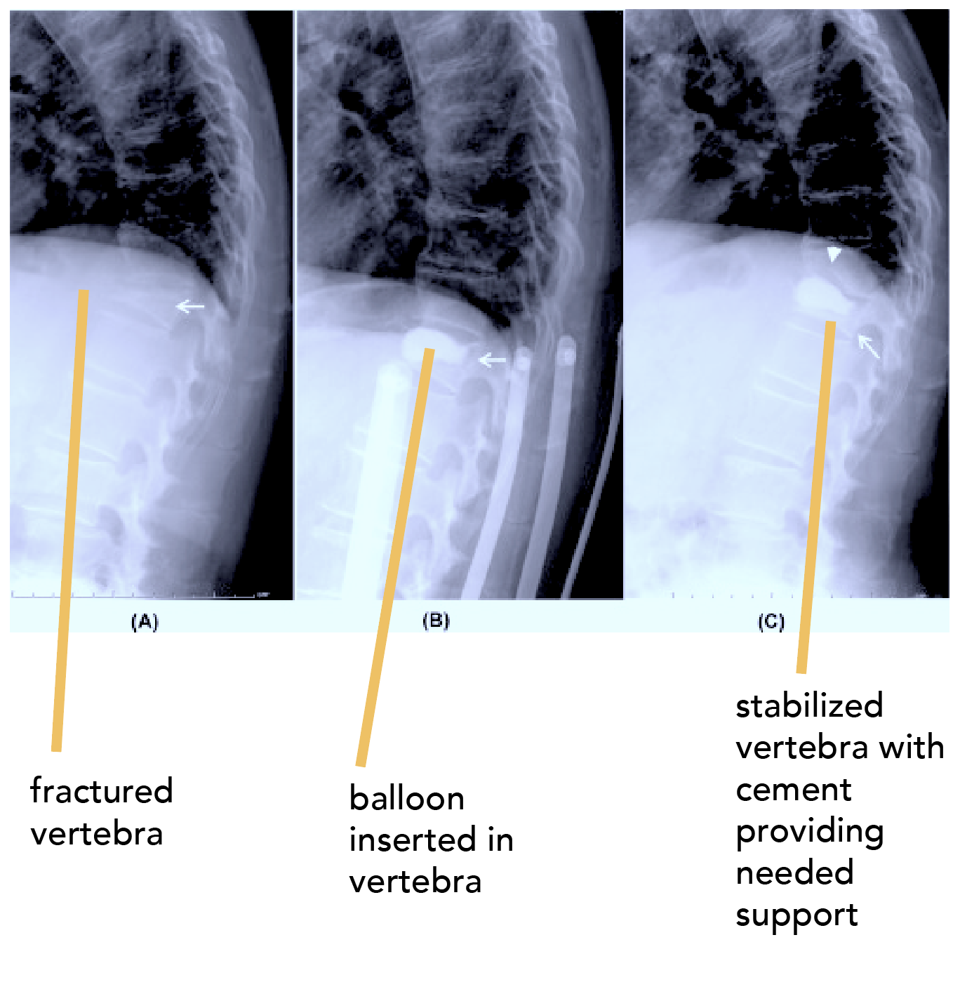img Nerve Root Blocks