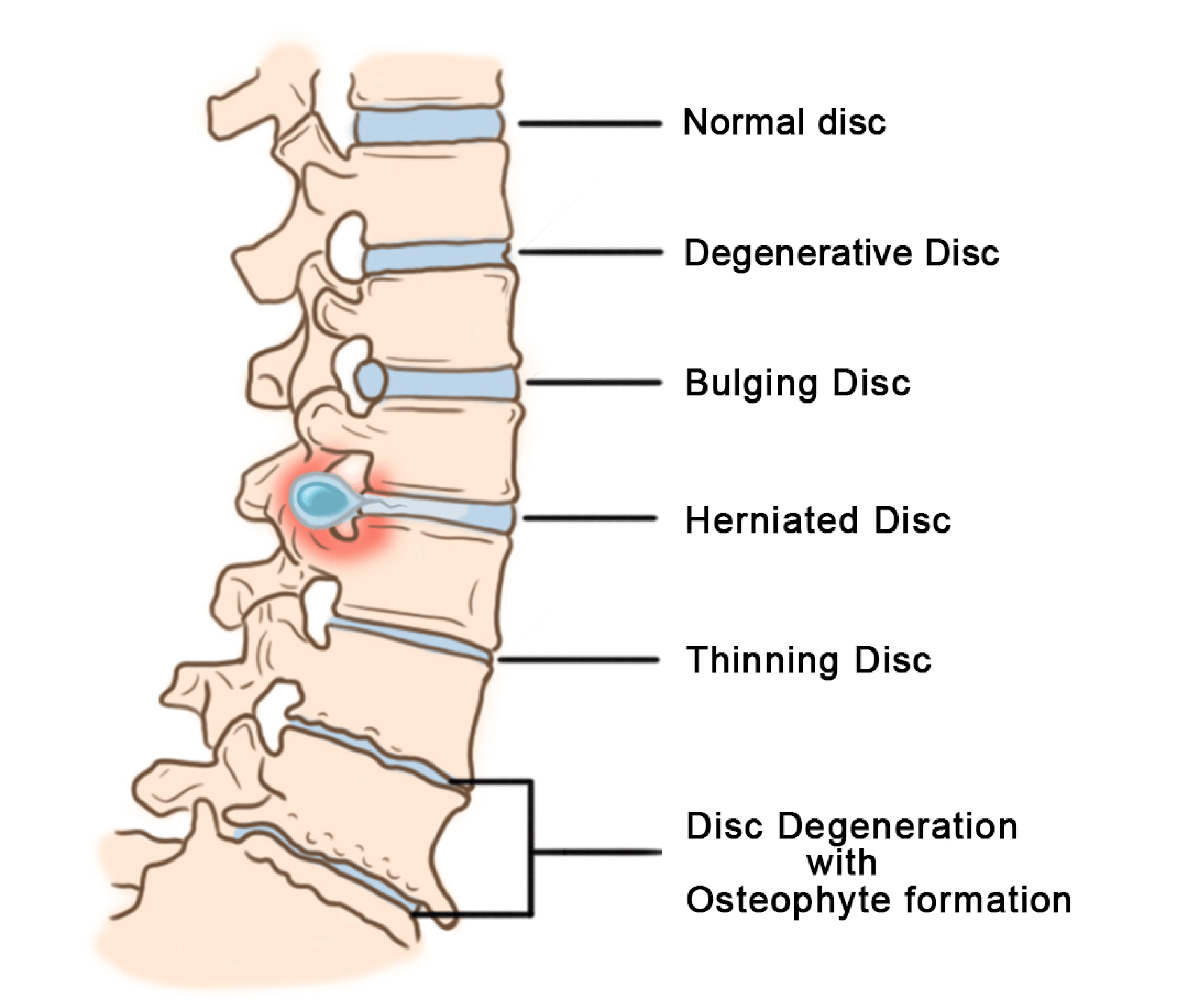 disc-herniation-1 Nerve Root Blocks