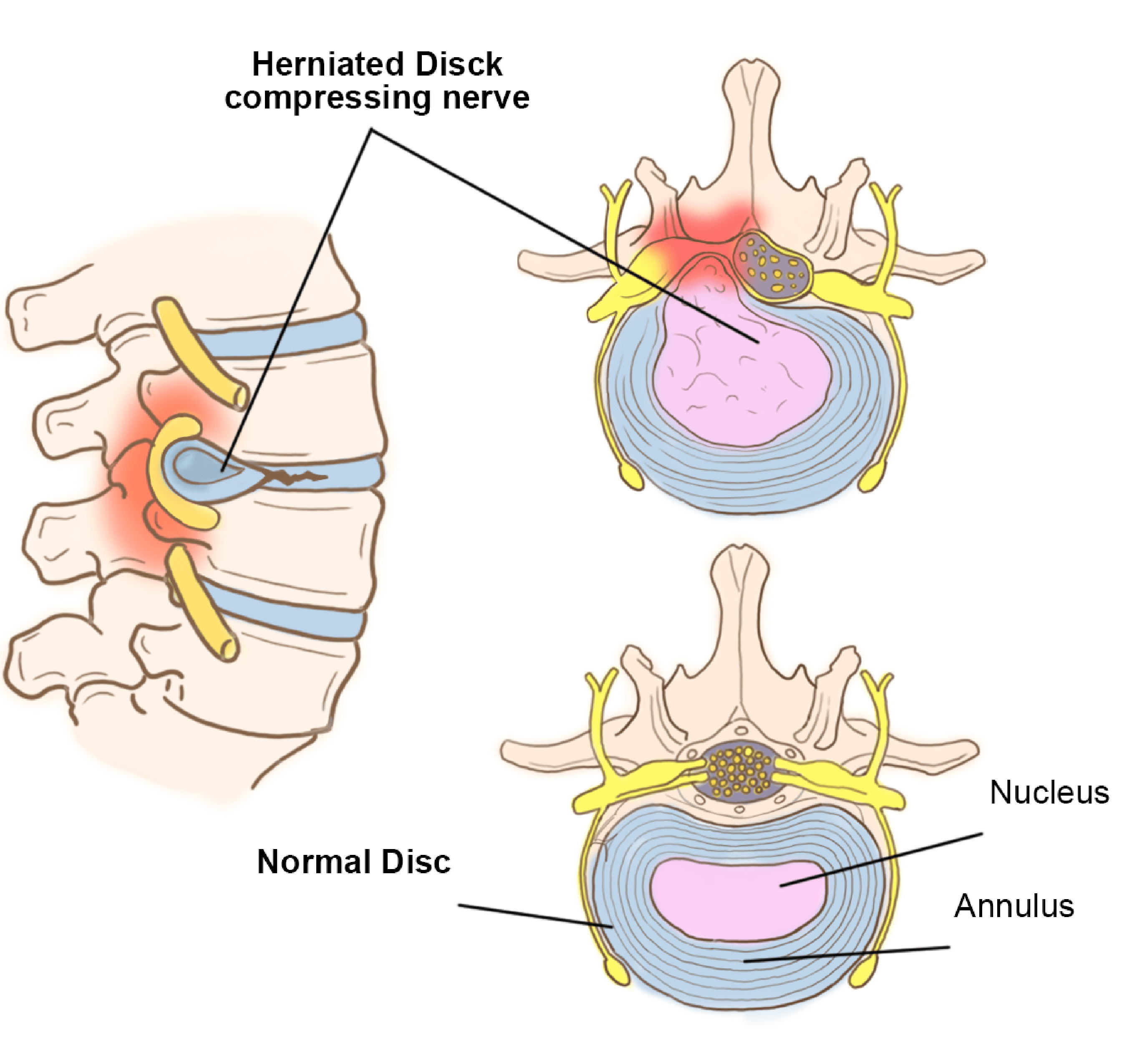 disc-herniation-2 Nerve Root Blocks