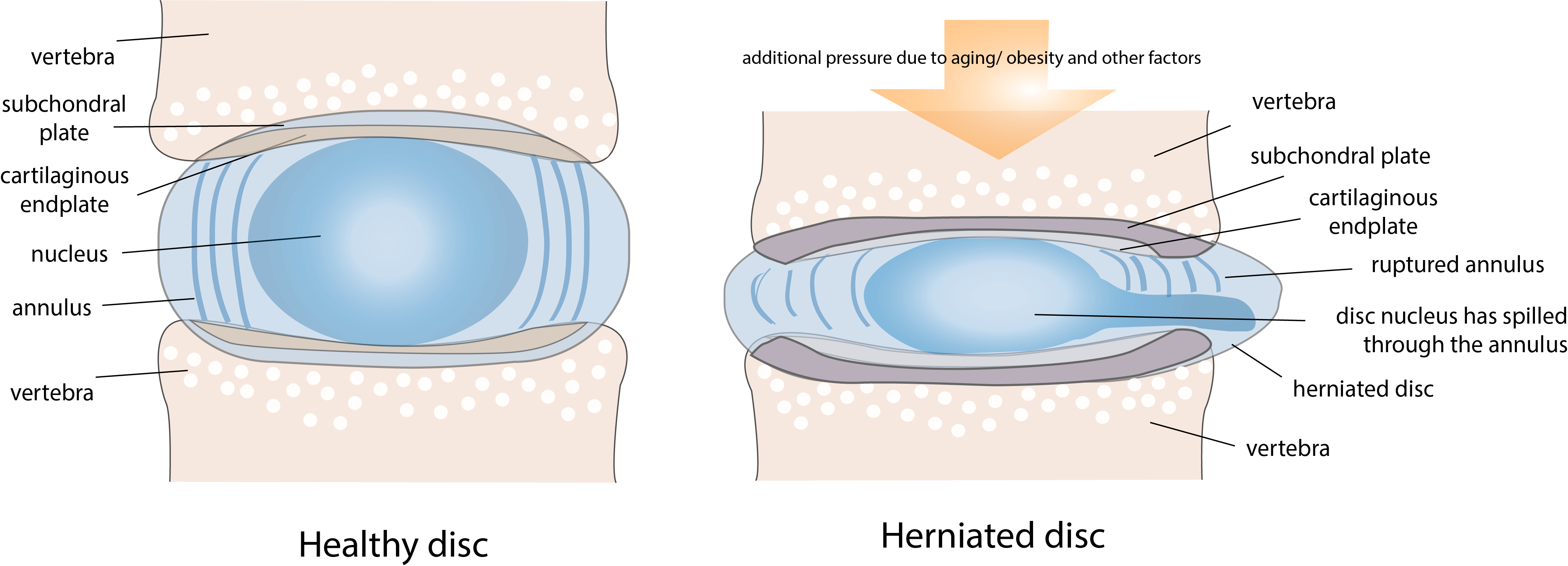 disc-herniation-3 Nerve Root Blocks