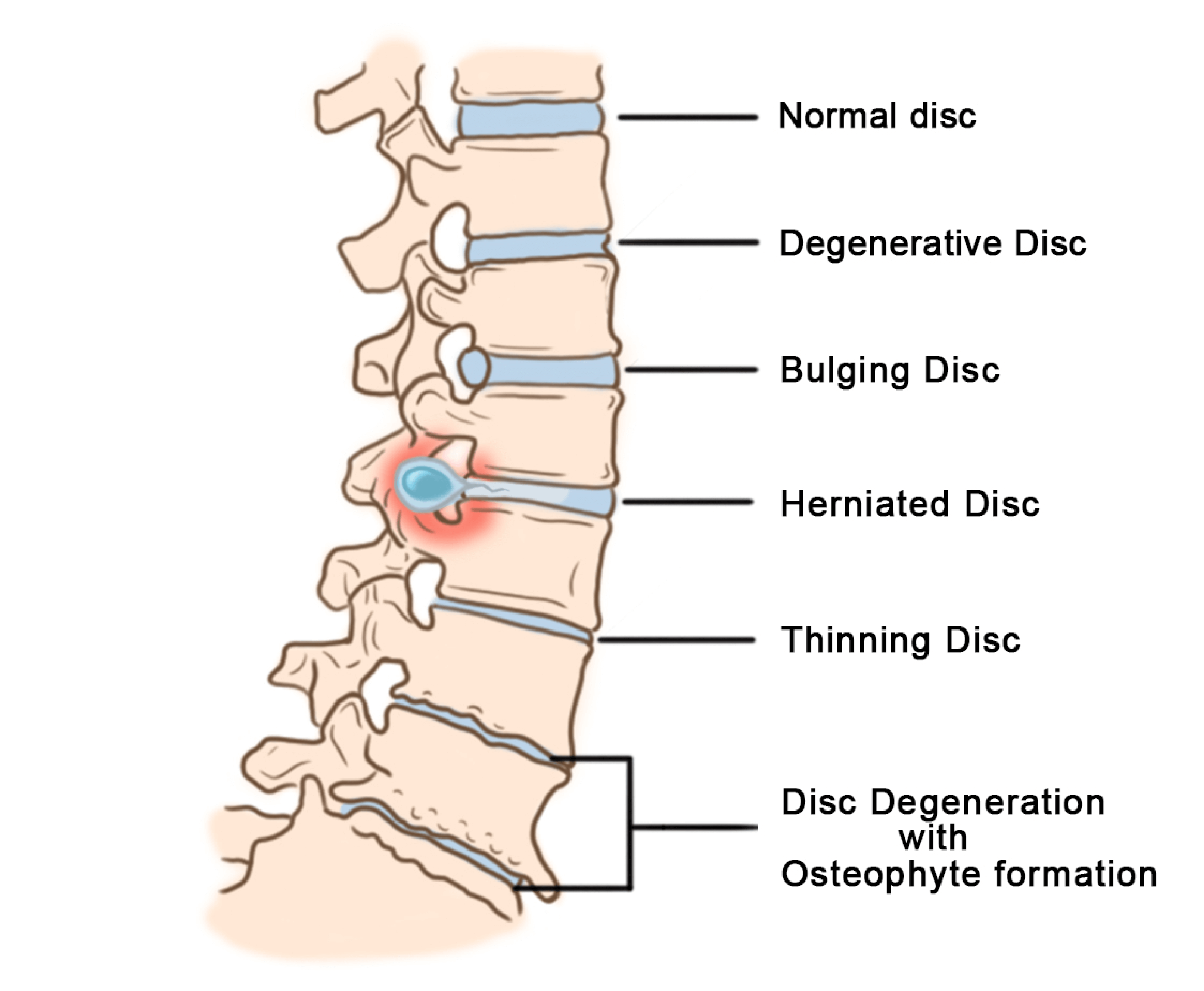 healthy-spine-3-01 Nerve Root Blocks