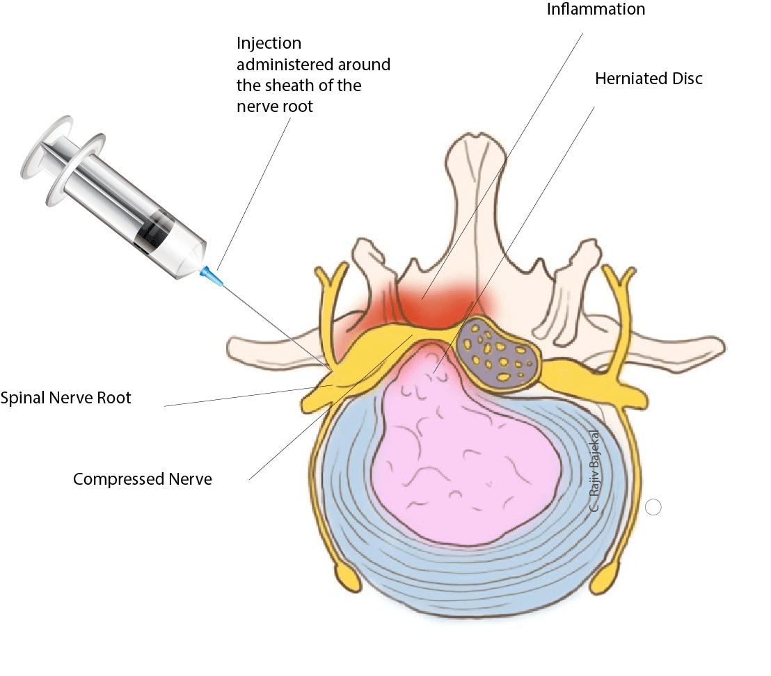 portfolio-01-01 Nerve Root Blocks