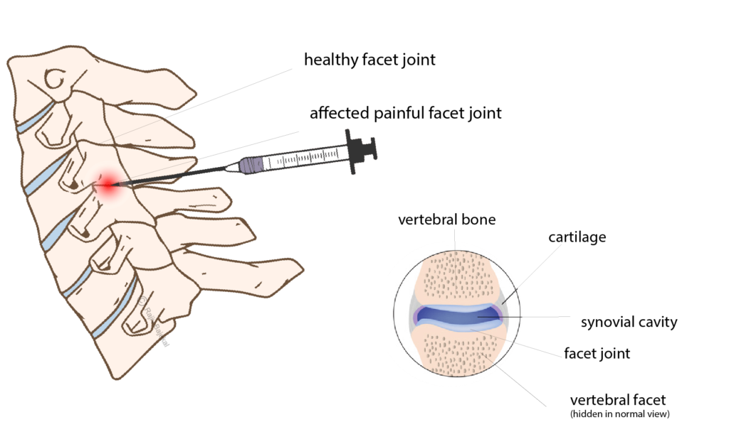 Facet Joint Injections Rajiv Bajekal