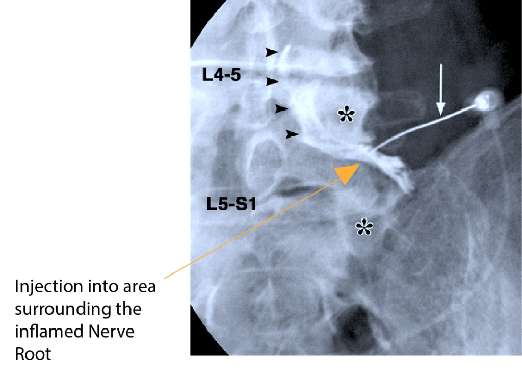 Nerve Root Blocks Rajiv Bajekal