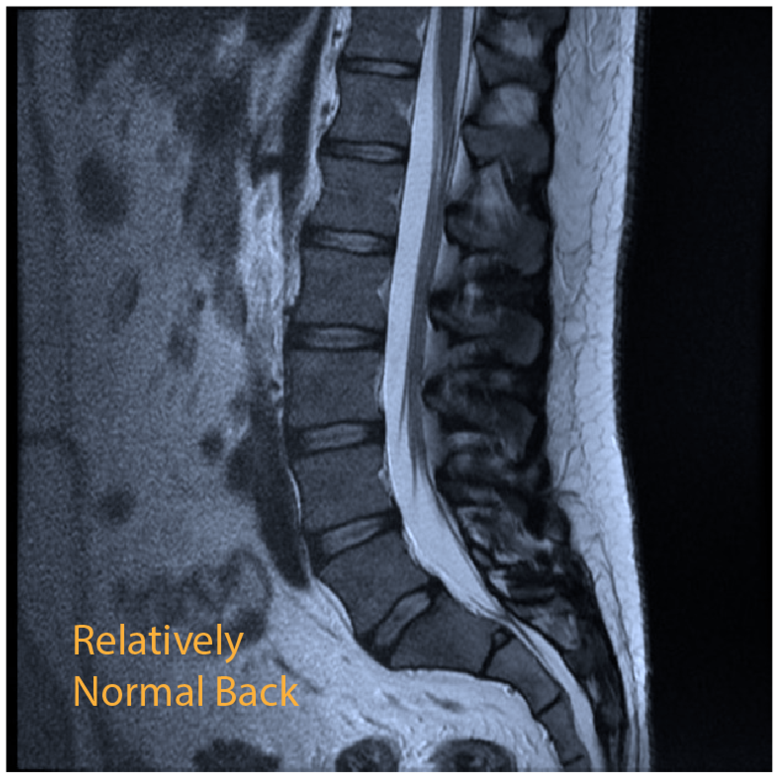 portfolio-3-13 Transforminal epidural x-ray
