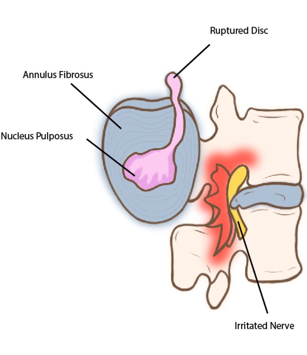 portfolio-3-05 Nerve Root Blocks