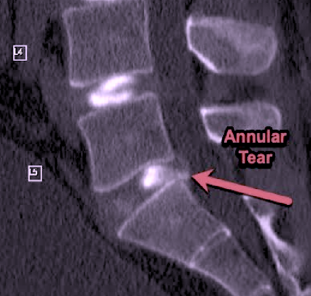 portfolio-3-06 Transforminal epidural x-ray