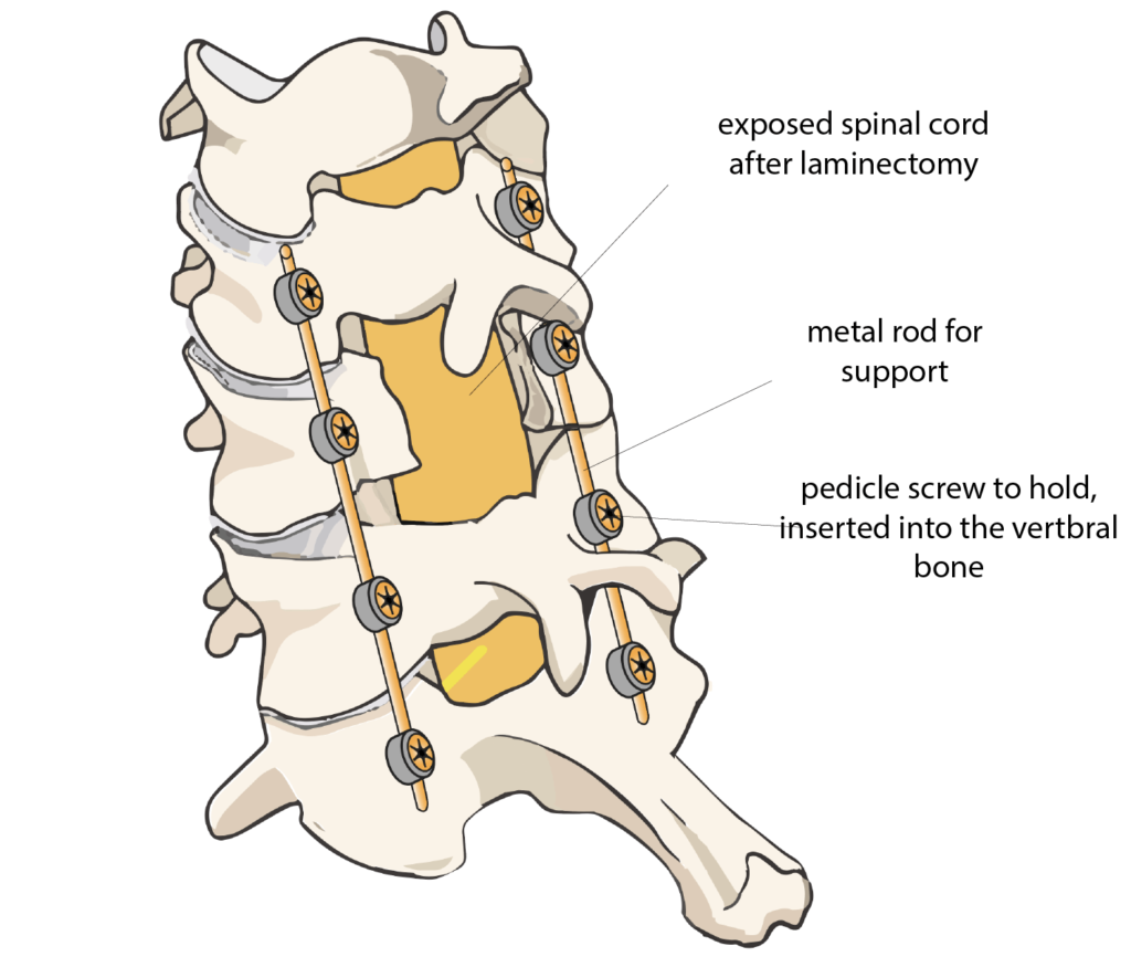 Spinal Fusion Rajiv Bajekal