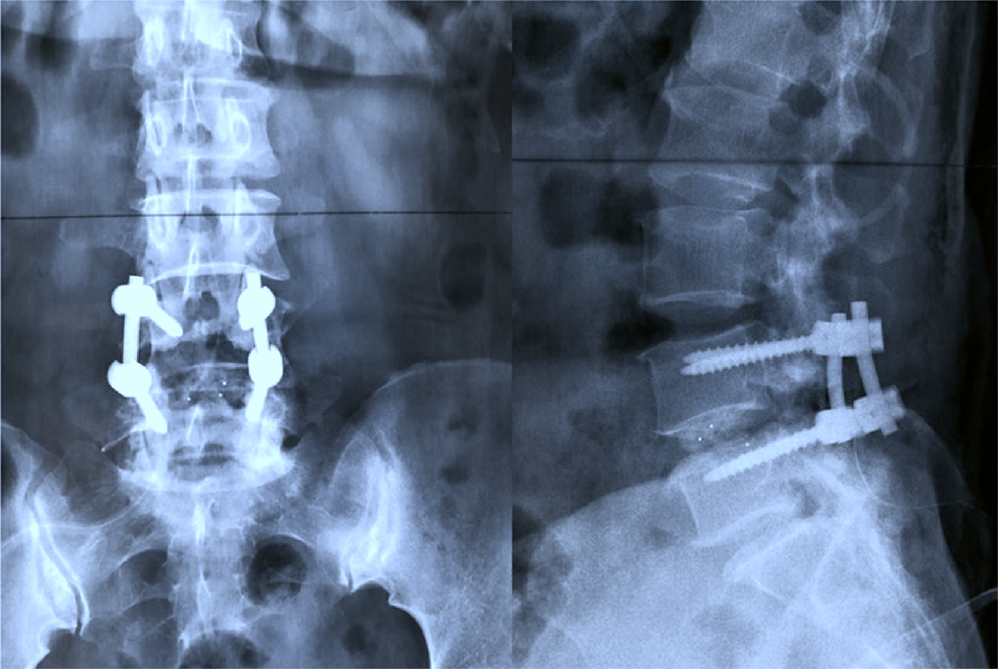 porfolio-2-06 Nerve Root Blocks